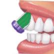 illessze a fogakhoz és segít megtartani a szálak helyes szögét a fogakhoz képest a tisztítás során az ívbe történő tisztítás klinikailag igazolt eredményeket hoz a többszintes bevágás az elülső,