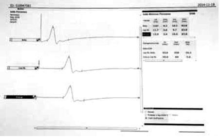 A fehér négyzetben a helyzetváltoztatás okozta műtermék látható Elektoneurographia (ENG). A polyneuropathia igazolására minden betegünknél alsó végtagi elektroneurographia történt.