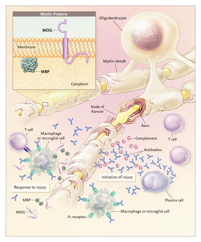 Akut SM laesio: helper (CD4+) T sejtek nő, suppressor (CD8+) T sejtek száma csökken relapszusban T-cell receptorok (TCRs) reagálnak az antigént prezentáló MHC II molekulákkal (macrophagon és