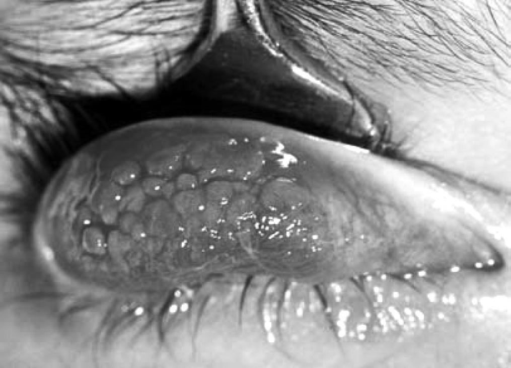 Vernalis conjunctivitis Szinte kivétel nélkül a tavaszi virágok pollenjei idézik elő. A betegség égő érzéssel, könnyezéssel, tavasszal kezdődik, az esetek 75%-ában 6-10 éves fiúkon.