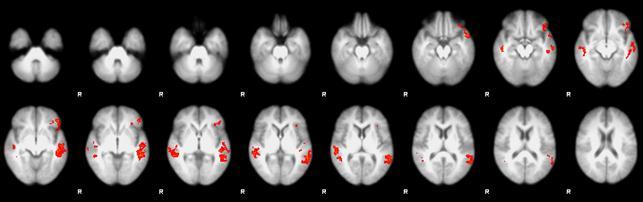 A csoportanalízisben a Z (T/F Gauss eloszlású) statisztikai képek küszöbölése Z>2.3 cluster, és a P=0.05 korrigált szignifikancia küszöbökkel történt. 2.