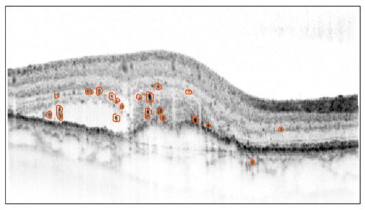 Hiperreflektív pontok detektálása és számlálása mély neuronhálók segítségével Kísérleteink során az OCT képekről kinyert képi jellemzőket felhasználva mély neuronhálókat (DNN) tanítottunk a