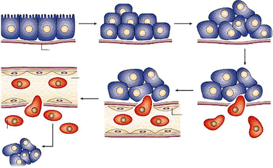 A metasztázis lépései normális epitélium alaphártya abnormális sejtosztódás jóindulatú daganat vér- vagy nyirokér endotélsejt