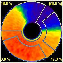 GATE szimulációval előállított NCAT fantom vizsgálata A verifikáció második lépésében az emberi mellkas MRI képek alapján készített matematikai fantomját, az úgynevezett NCAT fantomot [74] használtuk.