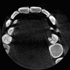 66 2.6. ábra Állkapocs metszetek CBCT felvételeken: a képpont mérete 200µm (bal) és 300µm (jobb).