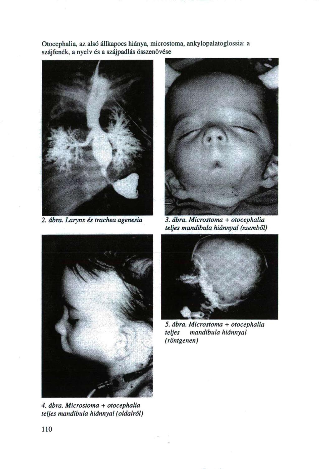 Otocephaiia, az alsó állkapocs hiánya, microstoma, ankylopalatoglossia: a szájfenék, a nyelv és a szájpadlás összenövése 2. ábra.
