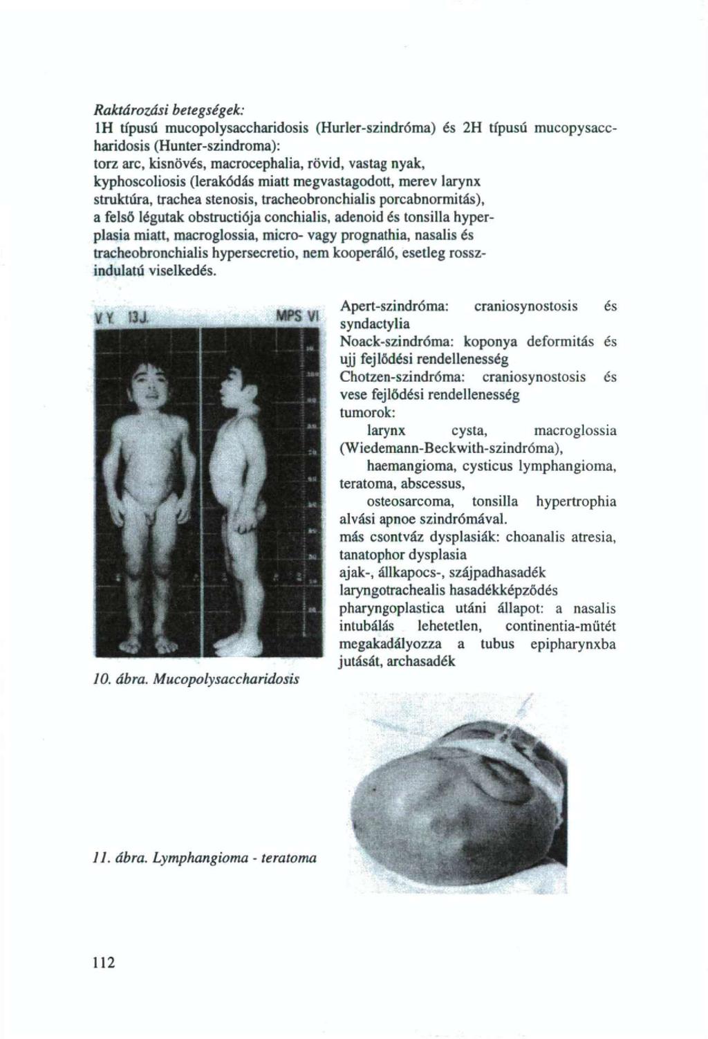 Raktározási betegségek: 1H típusú mucopolysaccharidosis (Hurler-szindróma) és 2H típusú mucopysaccharidosis (Hunter-szindroma): torz arc, kisnövés, macrocephalia, rövid, vastag nyak, kyphoscoliosis