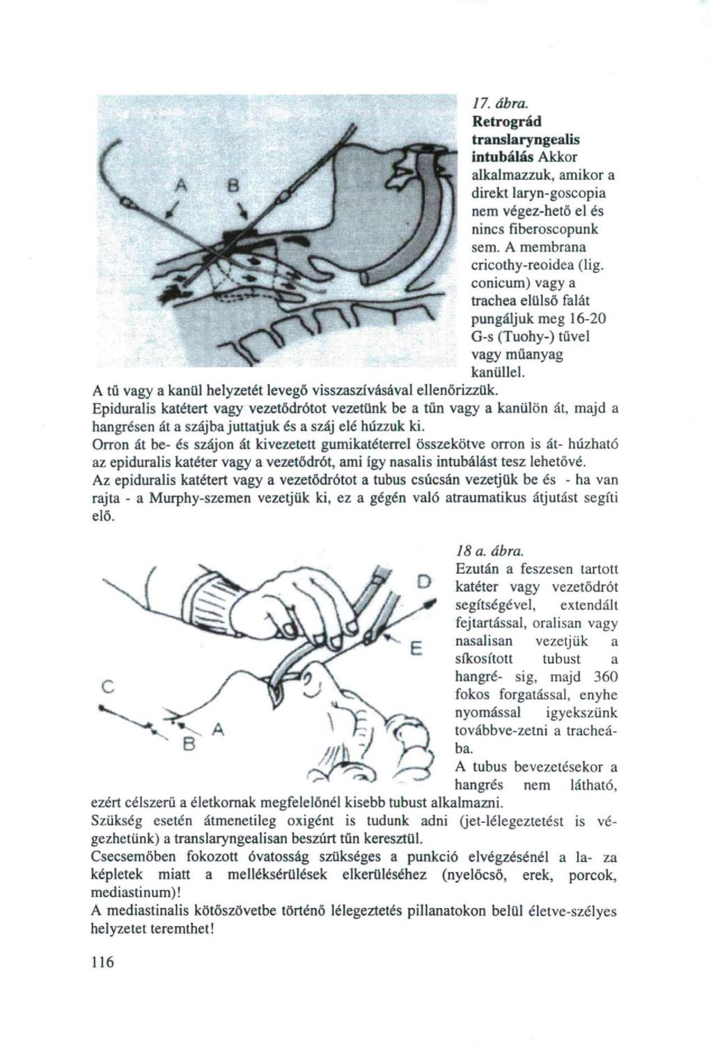 17. ábra. Retrográd translaryngealis intubálás Akkor alkalmazzuk, amikor a direkt laryn-goscopia nem végez-hető el és nincs fiberoscopunk sem. A membrana cricothy-reoidea (lig.