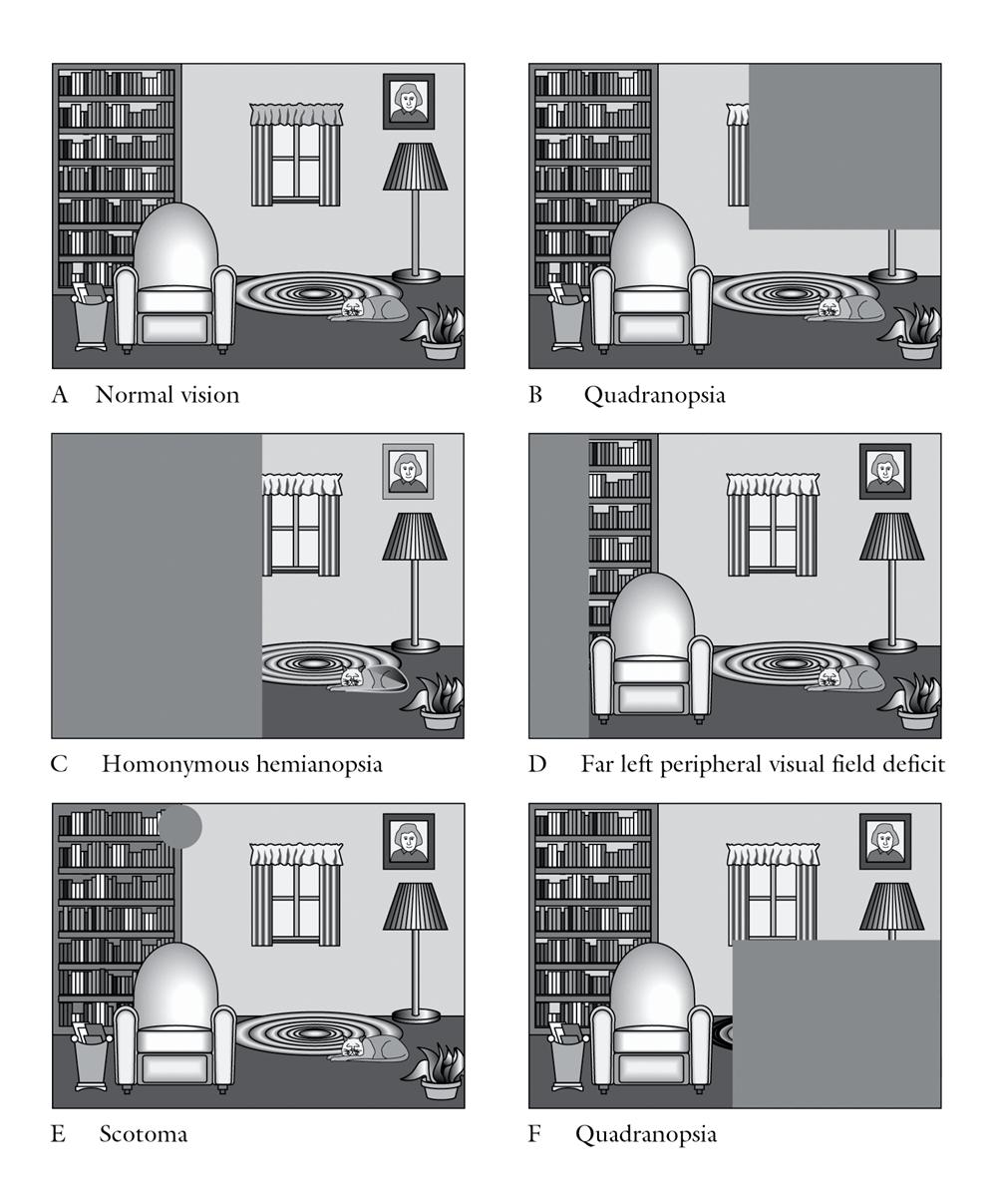 hemianópia (C) Bal homonym hemianópia (D) Bal felső kvadranópia (E) Bal homonym hemianópia a macula megőrzésével