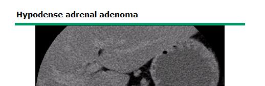 Mellékvese adenoma Keressük a