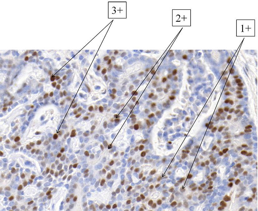 A cyclin D1 és Bcl-2 immunhisztokémiai reakcióik kiértékelésének alapját az 5. és 6. ábrák szemléltetik. 5.ábra.