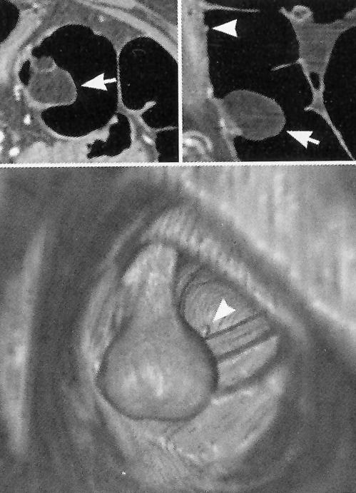 V. Kerek( lipoma) a