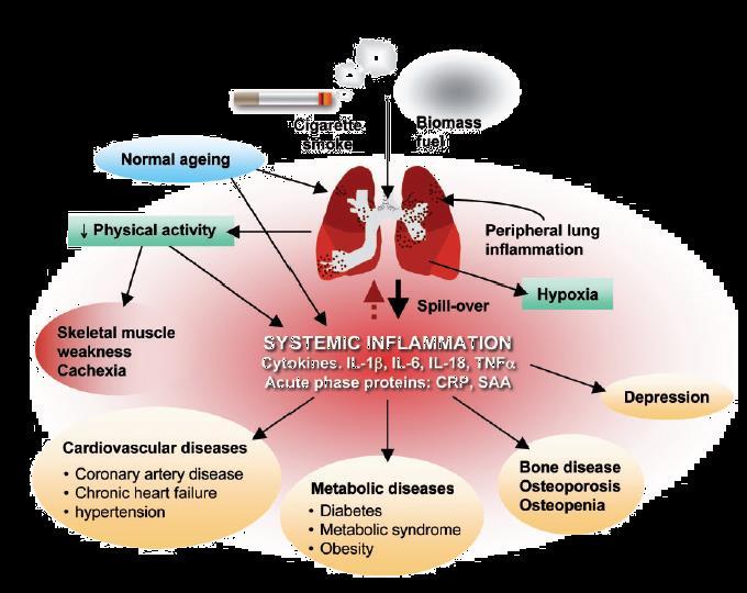 A COPD egy összetett