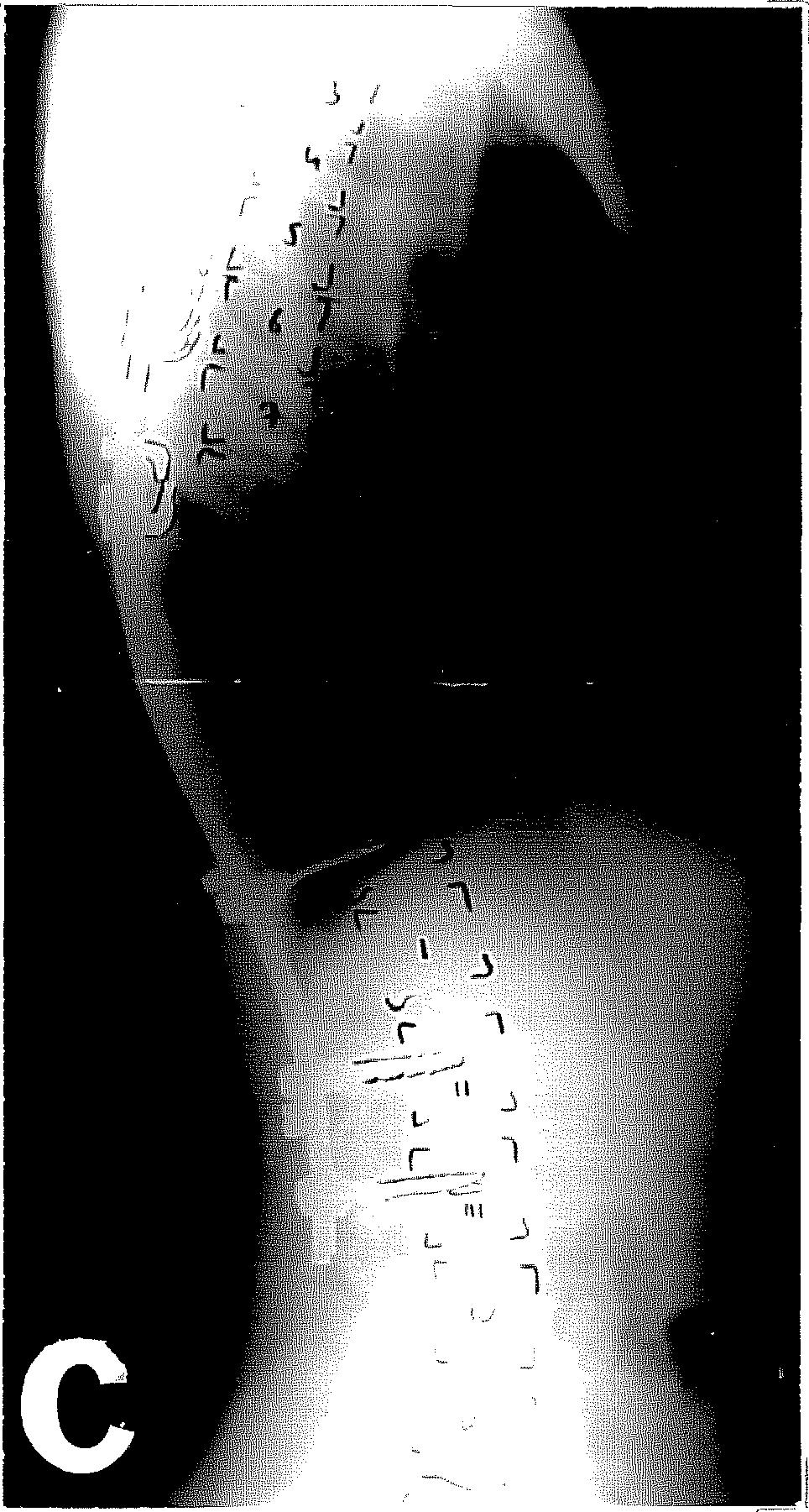 B: hyperextenziós funkcionális felvétel: a L3-as porckorong a horizontális discus.