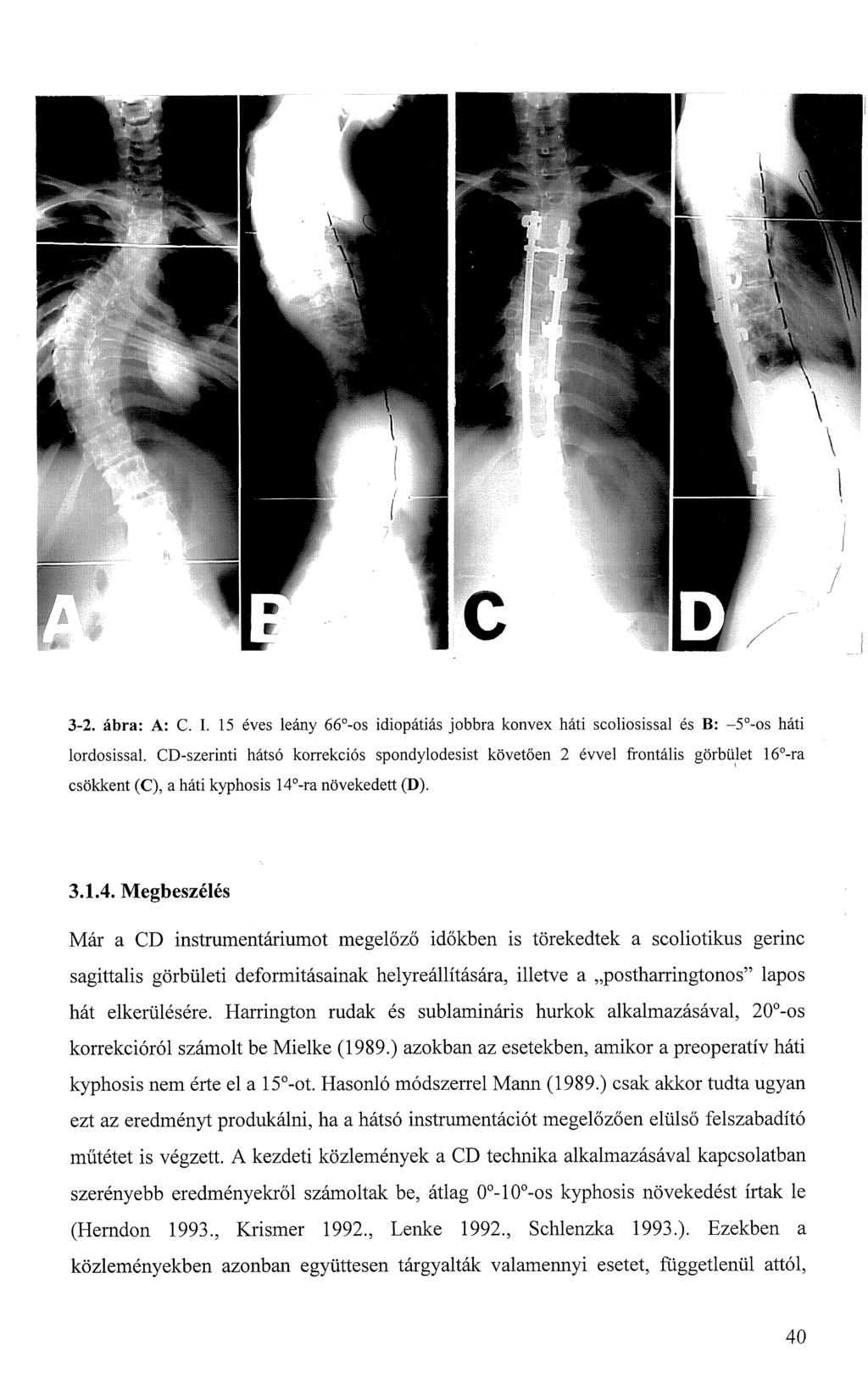 3-2. ábra: A: C. I. 15 éves leány 66 -os idiopátiás jobbra konvex háti scoliosissal és B: -5 -os háti lordosissal.
