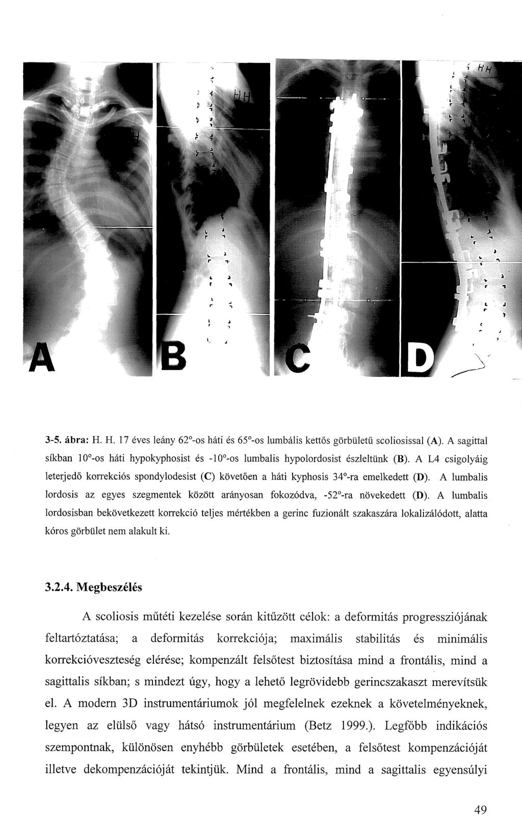 3-5. ábra: H. H. 17 éves leány 62 -os háti és 65 -os lumbális kettős görbületű scoliosissal (A). A sagittal síkban 10 -os háti hypokyphosist és -10 -os lumbális hypolordosist észleltünk (B).