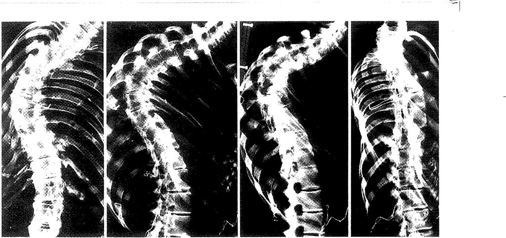 oldalfelvételen látható kyphosis pedig nem valódi kyphosis, hanem a nagyfokú csigolyarotáció következtében a sagittalis síkba áthelyeződött oldalirányú görbület. Peloux (1965.