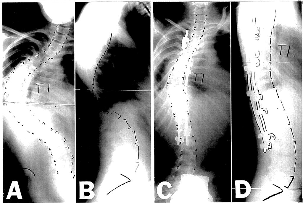 3-9. ábra: T. I. 13 és fél éves leány (A) 100 -os háti scoliosissal (T5-L1 között, punctum maximum: T9), 67%-os apicalis csigolyarotációval.