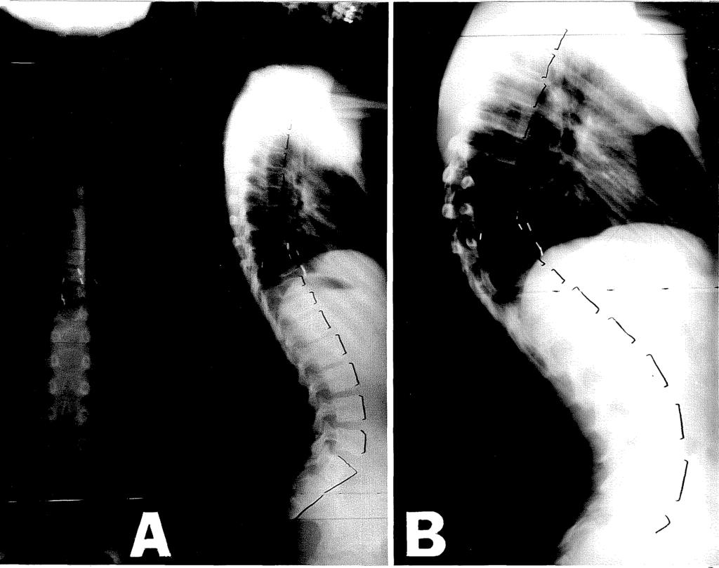 oldali thoracotomiából végzett elülső felszabadítást és aládúcolásos tibia-graftolást követően a kyphosis 41 -ra mérséklődött (4-2.