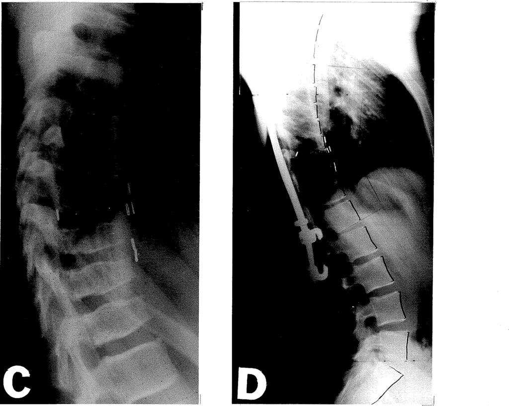 4-2. ábra C-D: Postirradiatiós háti hyperkyphosis. (lásd 2. esetismertetést). 3.