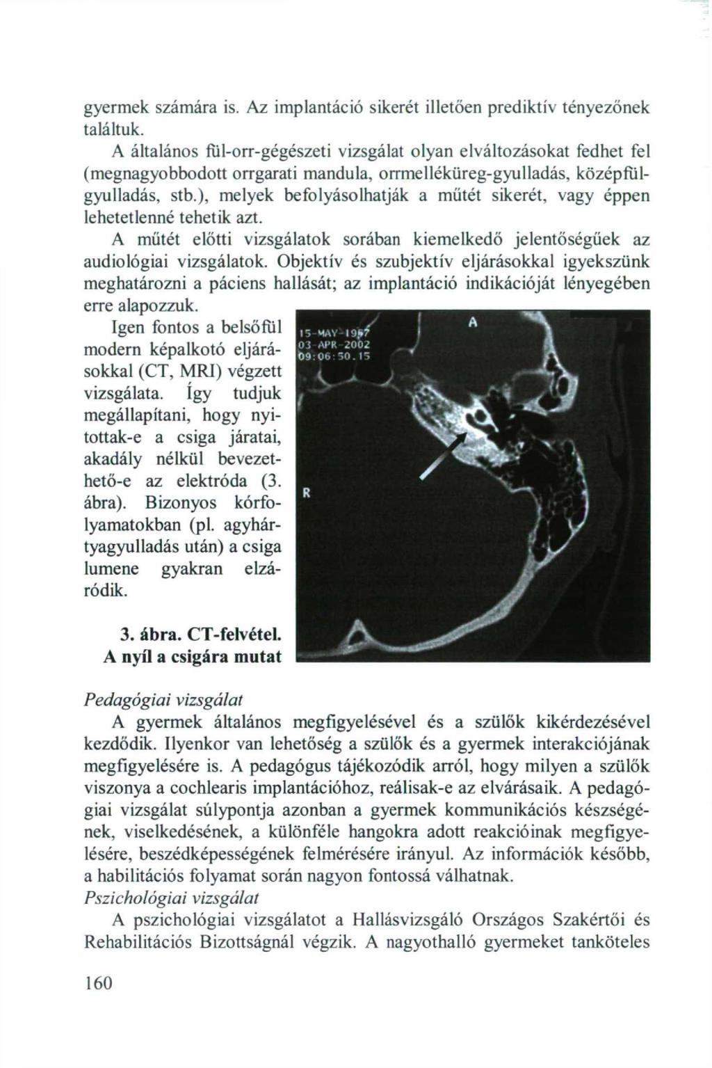 gyermek számára is. Az implantáció sikerét illetően prediktív tényezőnek találtuk.