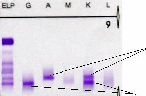 nehéz és egy könnyűláncban azonos magasságban, IgG lambda típusú monoklonális gammopathia