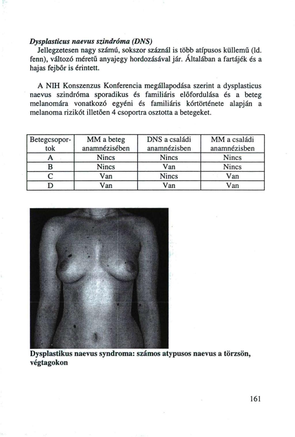 Dysplasticus naevus szindróma (DNS) Jellegzetesen nagy számú, sokszor száznál is több atípusos küllemű (Id. fenn), változó méretű anyajegy hordozásával jár.