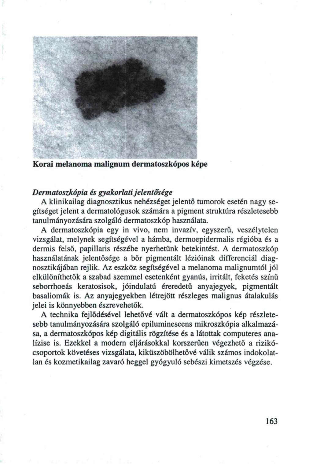 Korai melanoma malignum dermatoszkópos képe Dermatoszkópia és gyakorlati jelentősége A klinikailag diagnosztikus nehézséget jelentő tumorok esetén nagy segítségetjelent a dermatológusok számára a