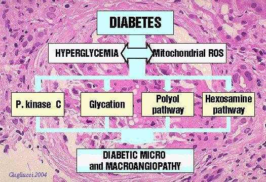 A diabétesz szövődményeinek oka Oxidatív stressz: Az intracelluláris hyperglycaemia megemeli a