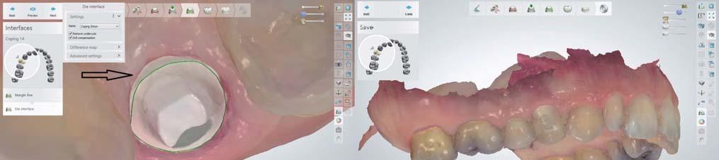 278 Magyar Fogorvos 2016/6 A szék mellett 5/a b. ábra: Implantátum fejről készült digitális lenyomat.