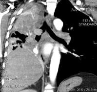 () A coronlis síkú CT-felvételen (MIP rekonstrukció) jo fôhörgôen 15 mm átmérôjû endoronchilis növedék árázolódik, mögöttes telectsiávl. () Az elváltozás virtulis ronchoszkópiás megjelenítése.