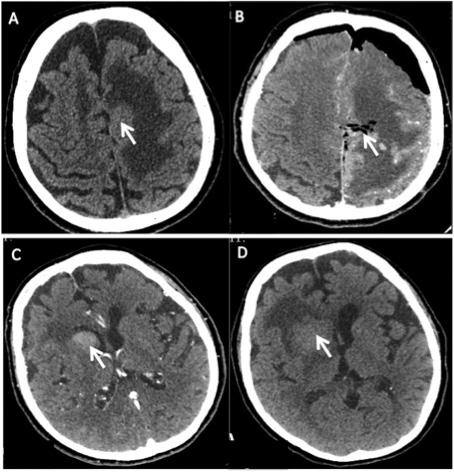 2. ábra A Az axiális síkú CT-felvételen kontraszthalmozó góc látszik a bal oldali frontalis lebenyben. B Bal oldali craniotomiát követő állapot, a tumor eltávolításra került.