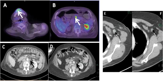 Forrás: Szent János Kórház, CT CT = komputertomográfia 3. ábra A B Submandibularis (A) és mesenterialis (B) nyirokcsomókban FDG-halmozás mutatható ki. C D 2015. november (C) vs. 2016.