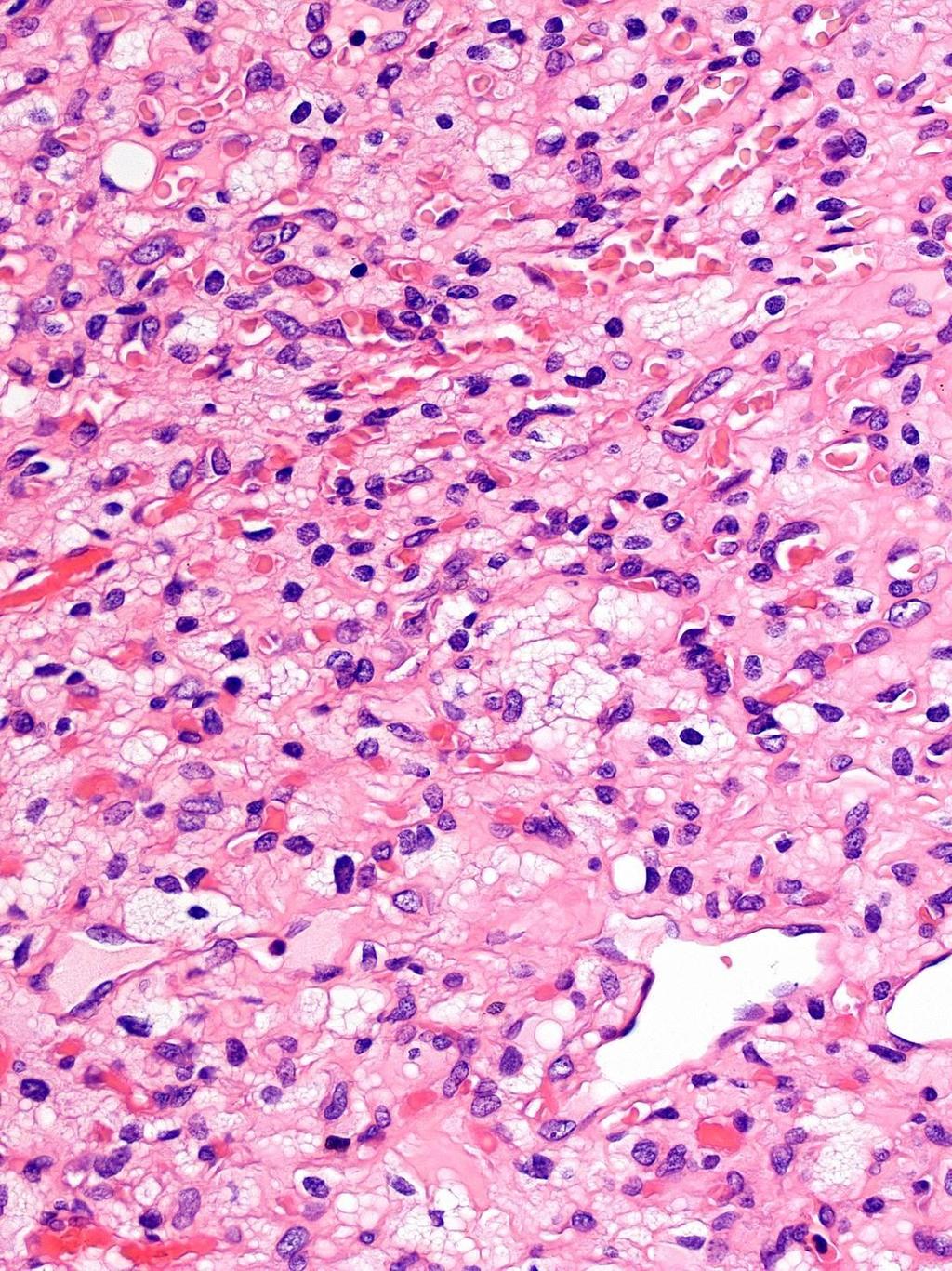 Bal: Hemangioblastoma; Jobb: