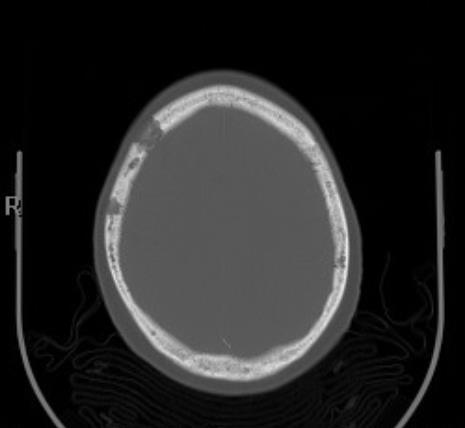 6. ábra A myeloma multiplex CT képe 3.3 MR MR felvételeken jól ábrázolódik a myeloma multiplex. T1-súlyozott felvételen a zsírszövet megnövekedett jelintenzitása figyelhető meg a csontvelőben.