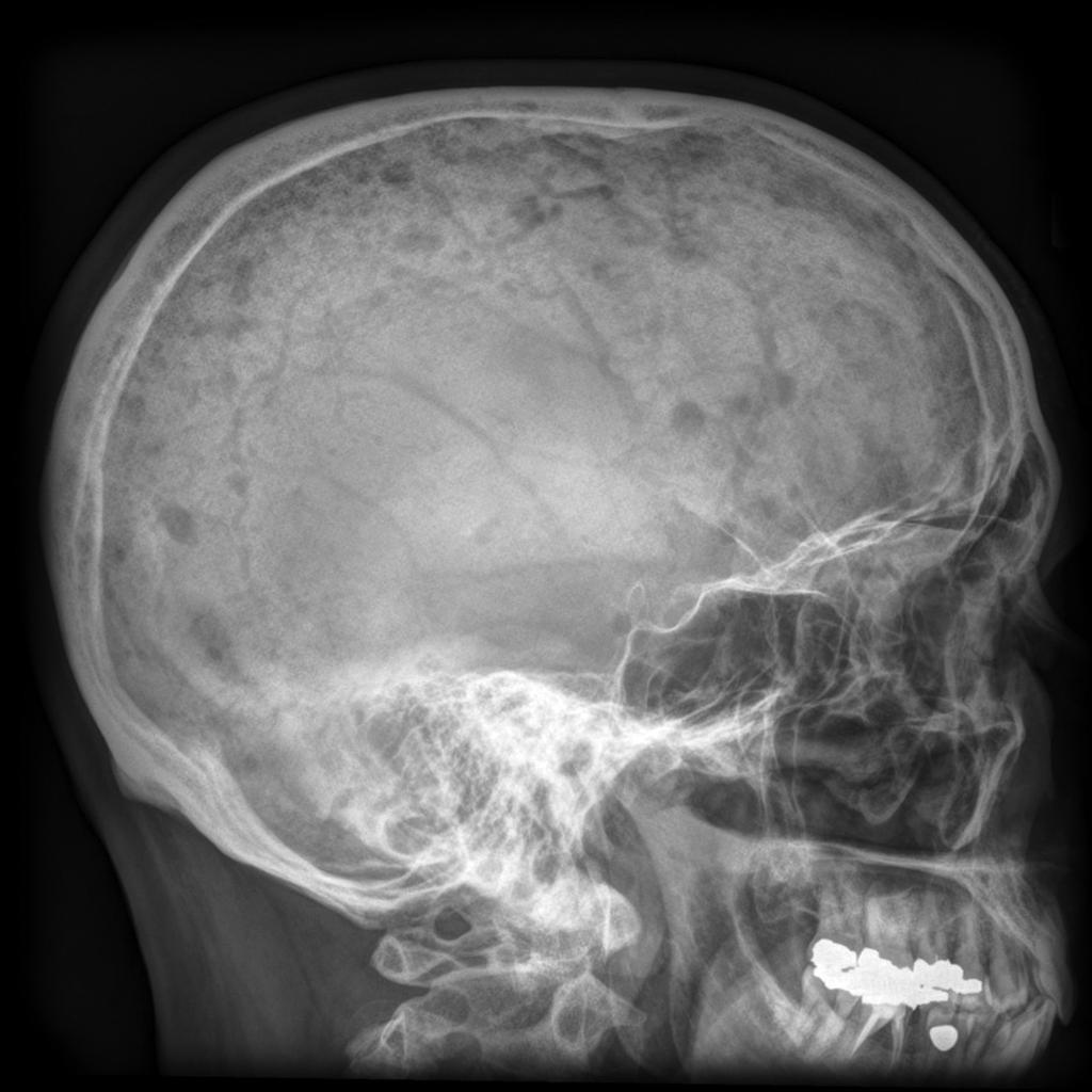 szenvedhetnek. A plasmocytoma a legyakoribb malignus csonttumor, 50-70 éves kor közötti, gyakrabban férfiak szenvednek a kórtól.