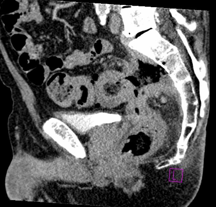 abscessus