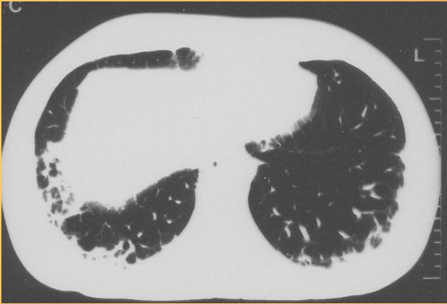 Lupusos tüdőfibrosis Tünetei: csökkent terhelhetőség,
