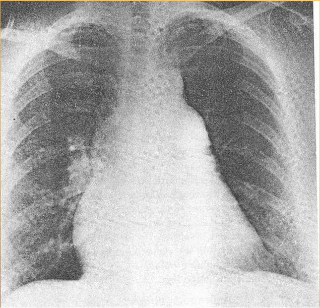 Pulmonalis hypertonia SLE-ben Rizikó tényezők: - Aktivabb kórlefolyású alapbetegség - Reuma faktor (RF) pozitivitás -Raynaud