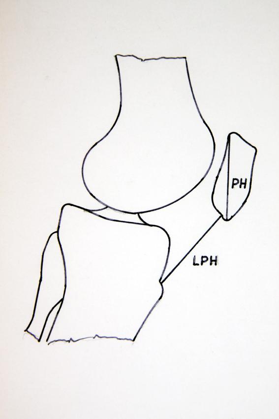 1. ábra. Az Insall Salvati-index (ISI) a ligamentum patellae hosszának (LPH) és a patella oldalirányú felvételen mérhető legnagyobb hosszának (PH) a hányadosa. A normálérték 0,8-1,2.