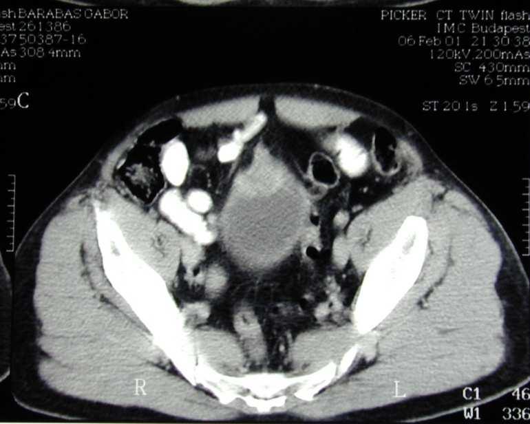 Urachus carcinoma Localisatio alapján is osztályozzák Dome / elülső