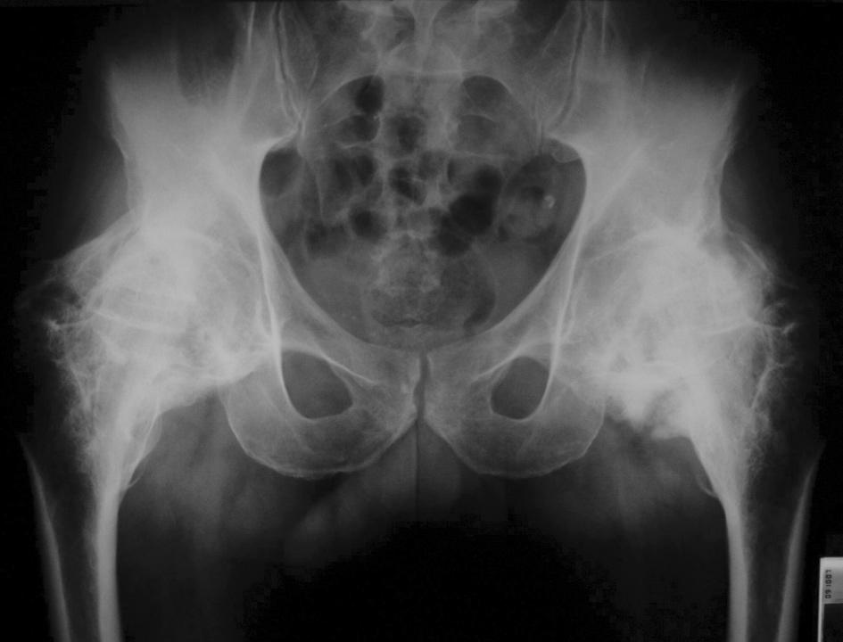 A baleset után 8 hónappal készült röntgen felvételeken mindkét csípőízület körül (a) és a jobb térdízület körül (b) HO