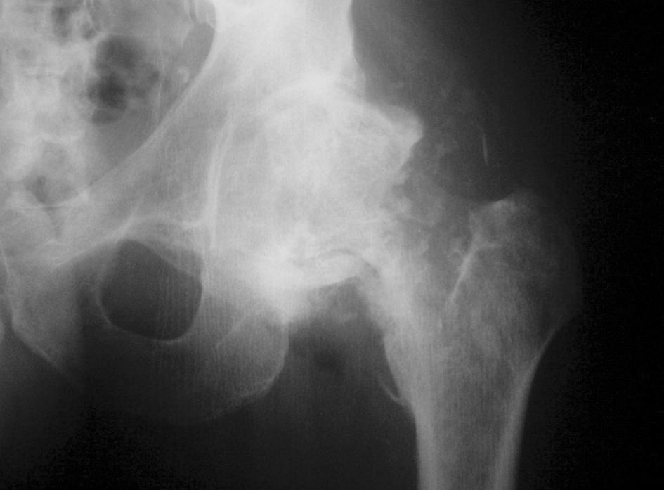 A posztoperatív röntgenkép (d) jól mutatja a HO-s lágyrész-szövet massza eltávolítását a bal  Két héttel a műtét utáni
