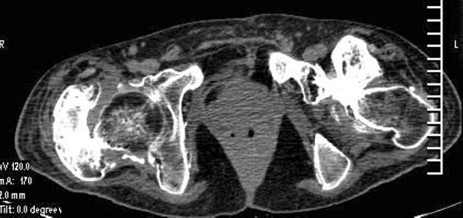 (b) és 3D CT (c) mutatja mindkét csípőízületnél az ankylosist okozó HO képződést.
