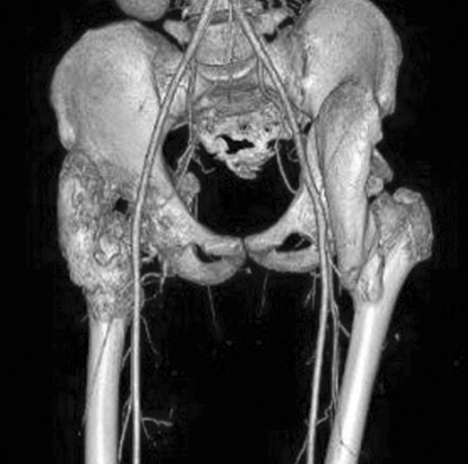Posztoperatív röntgen kép a bal oldali csípőről (d) az arthrolysis után, melyen már nem látható a