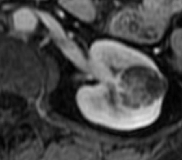 Angiomyolipoma T1 in