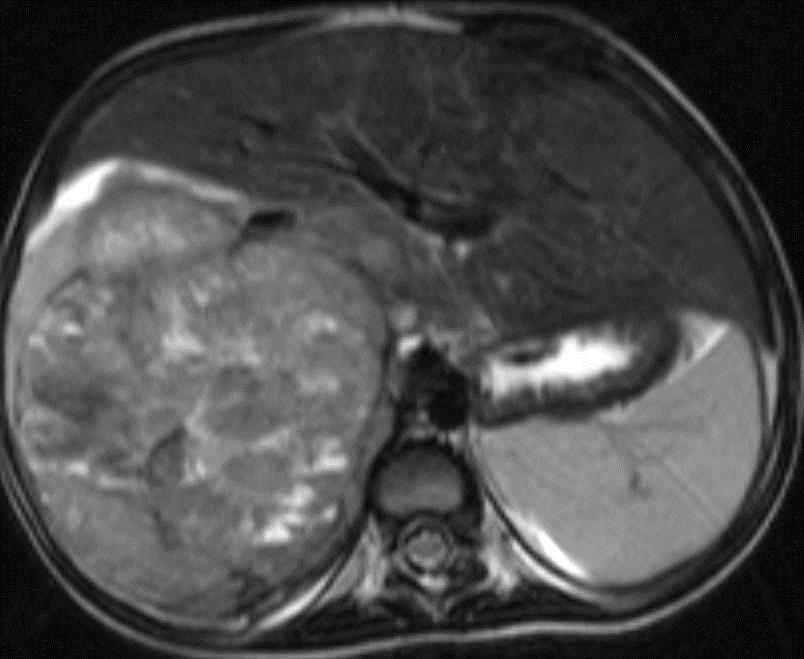 Carcinoma Ritka, de rossz kórjóslatú Lehet hormon termelő v.