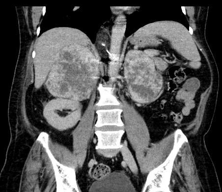 Metasztázis Gyakori primer tumor: tüdő, emlő, pancreas, vese, melanoma, lymphoma Általában kétoldali Ismert malignoma esetén