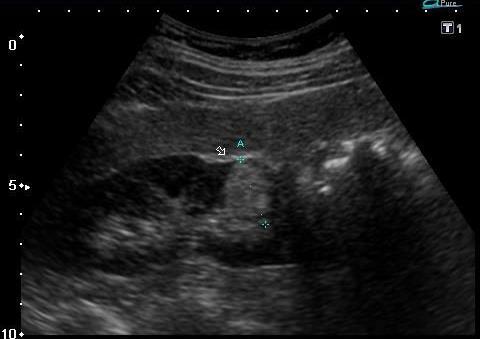 Jóindulatú daganatok Ritka: adenoma myoma fibroma haemangioma Gyakori: angiomyolipoma (hamartoma) Dg: UH - ált.