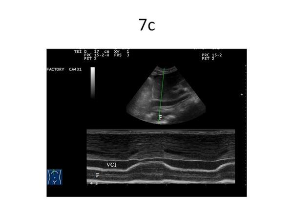 10. oldal, összesen: 11 oldal 7. ábra. Vena cava inferior sniff teszt. a) A VCI legnagyobb átmérője (kaliperek) sagittalis síkú ultrahangképen, közel a jobb pitvarhoz, a rekesz alatt, belégzéskor.